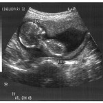 Fetus At 4 Months